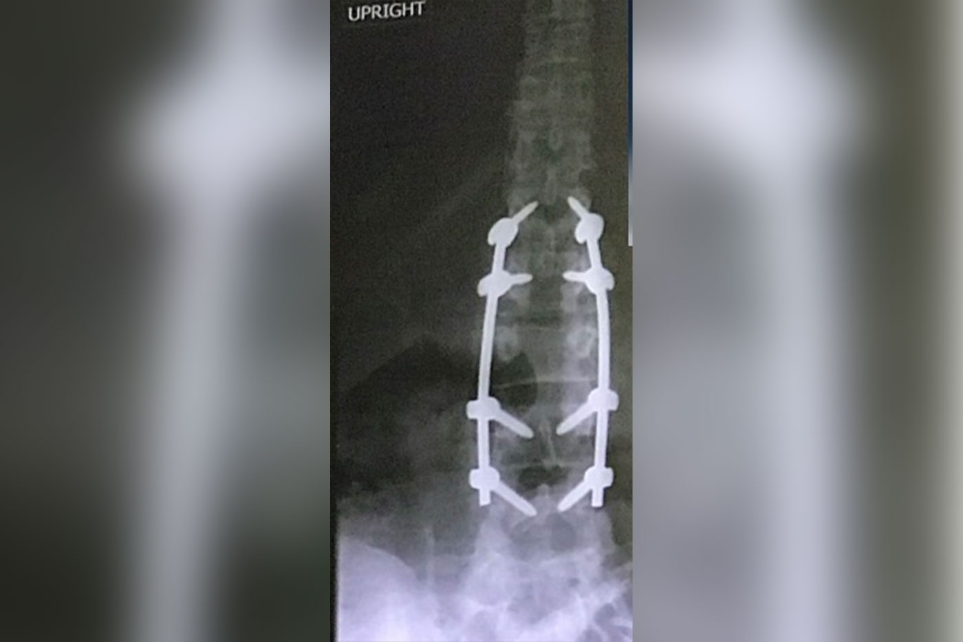 Spinal fusion